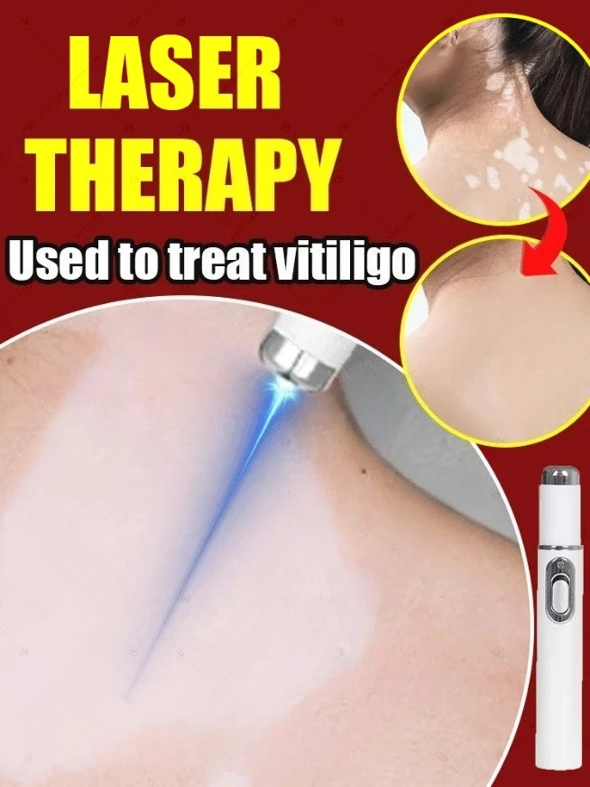 il laser blu migliora il vitiligine, strumenti infermieristici di vendita caldi 2025