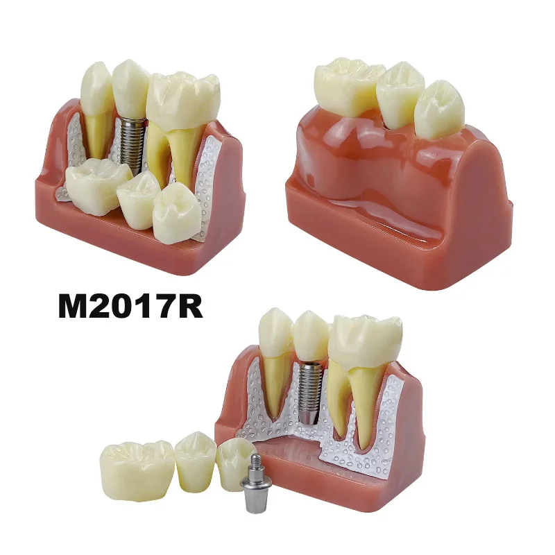 4 Times Implant Teeth Model With Crown & Bridge Removable  Implant Analysis Crown Bridge Removable Model Teaching Demonstration