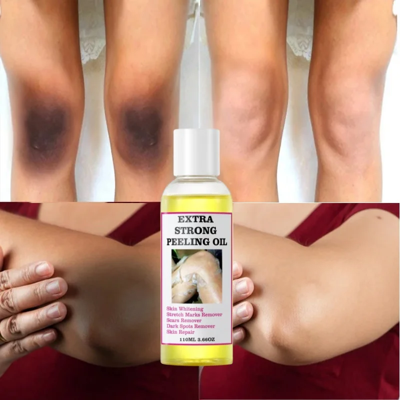 Yellow Peeling Oil Exfoliating Bleaching Dark Skin Spots Knee Finger Remove Dead Skin Melanin Whitening Brighten Body Skin Care