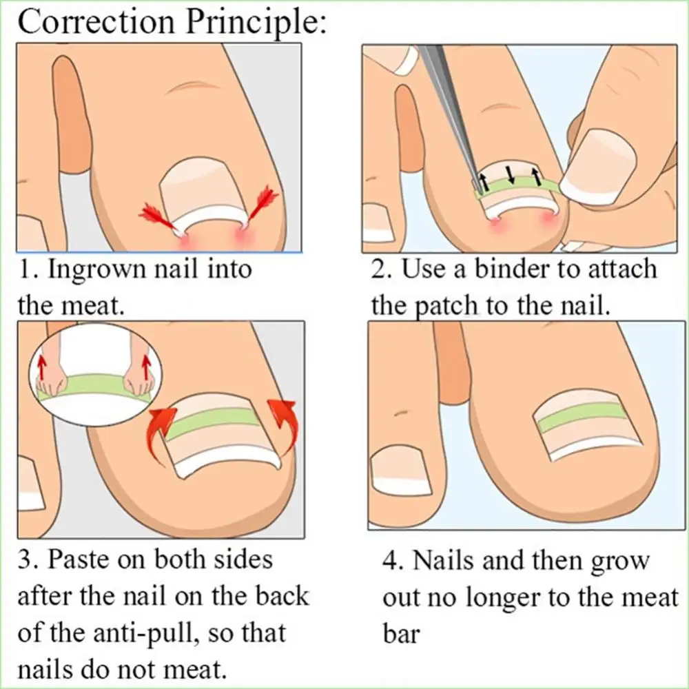 10pcs Ingrown Toenail Correction Tool Ingrown Toe Nail Treatment Elastic Patch Sticker Straightening Clip Brace Pedicure Tool