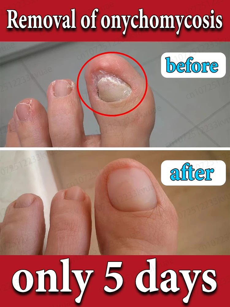 

Repair onychomycosis and give your nails a new lease of life