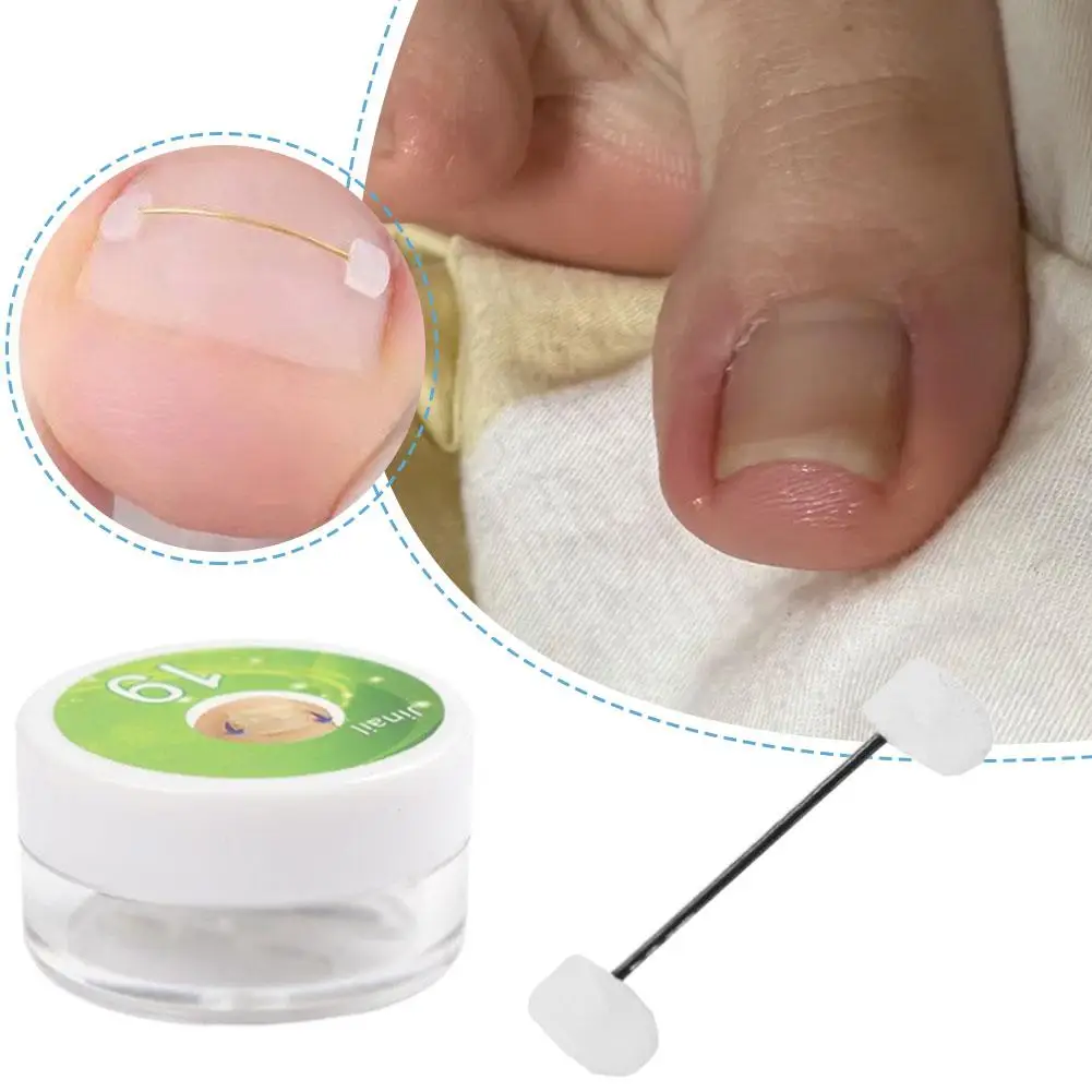 Ingrown Toenail Cor…