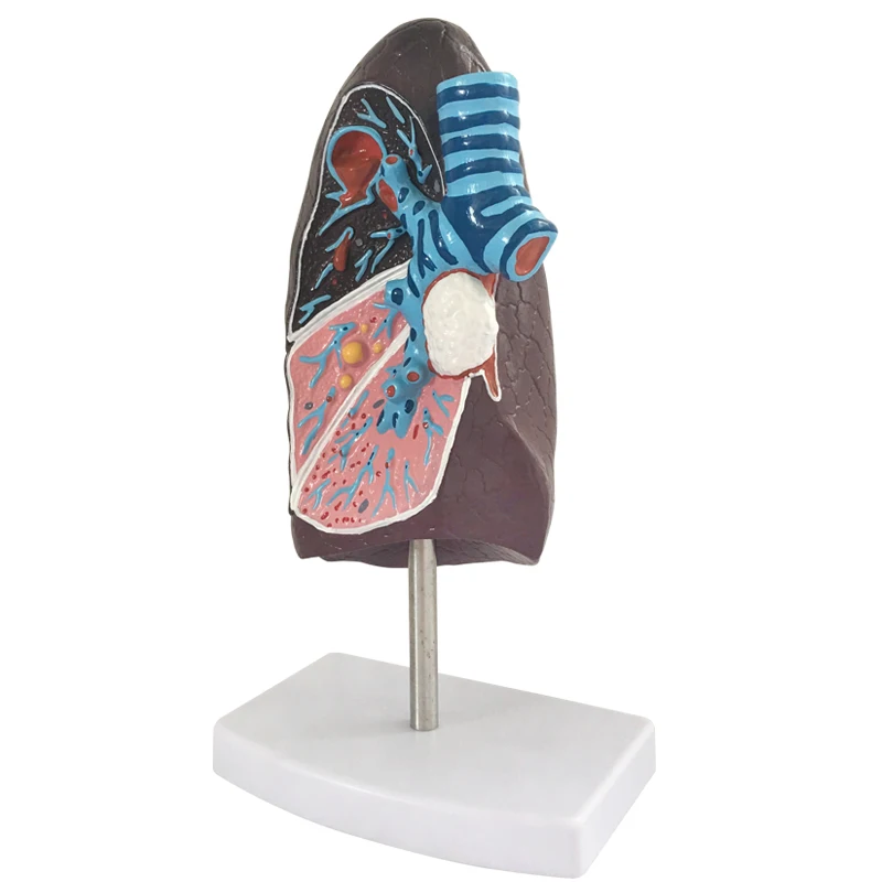 Human Lung Anatomical Model Smoker's Tuberculosis Pathological Lung Model Medical Research School Teaching aid