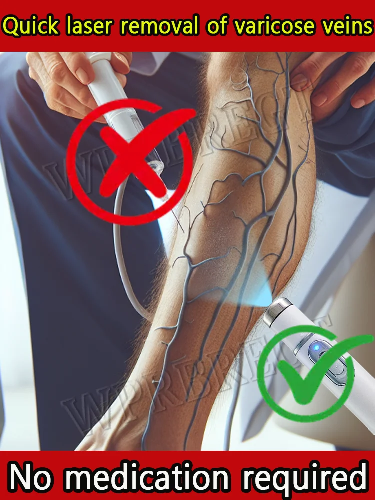 

New upgraded laser pen effectively and quickly removes varicose veins, phlebitis, spider legs