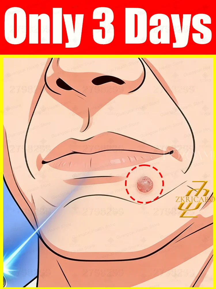 

Blue light pen for removing body warts, wart care tools, unisex, suitable for all ages, promotional discount, free shipping