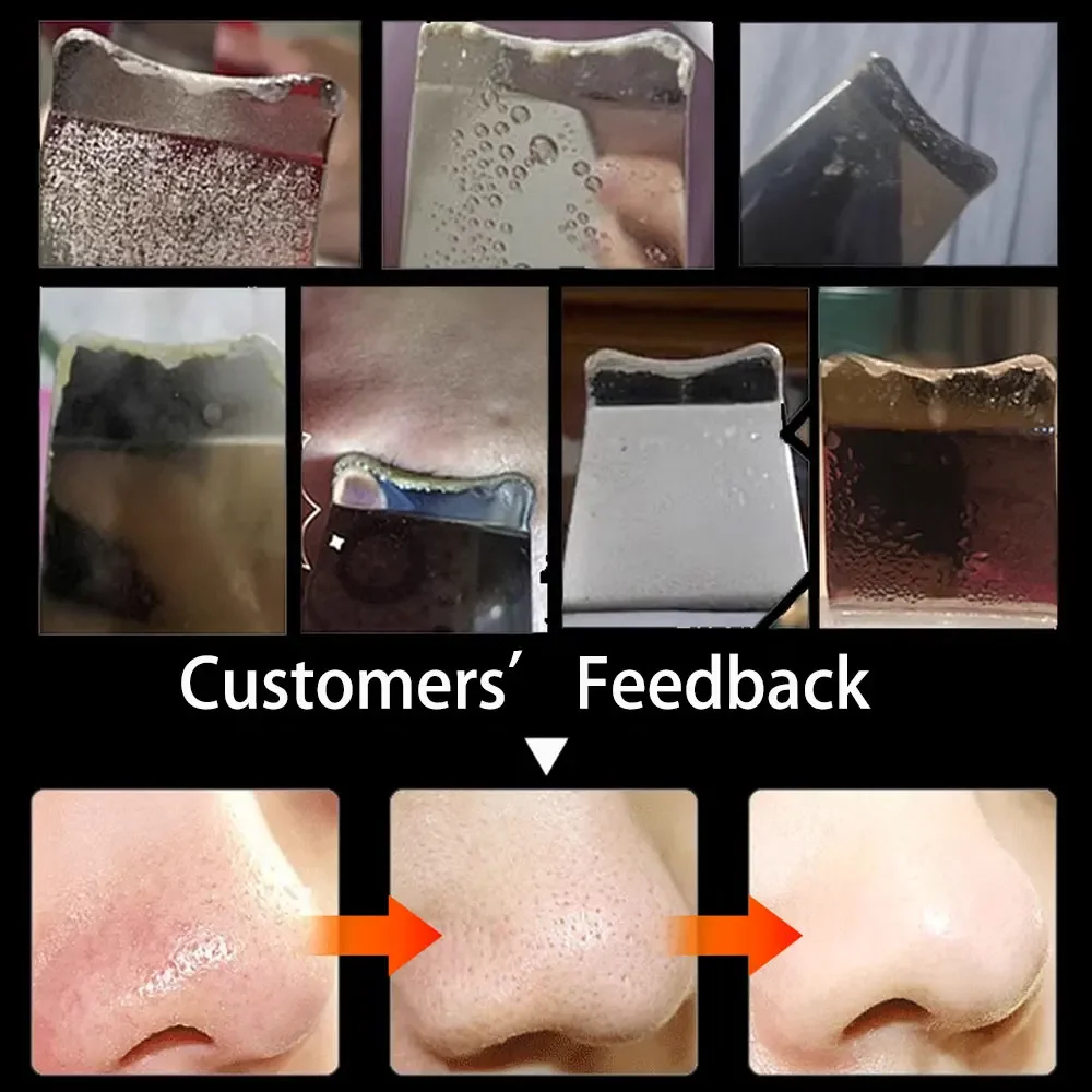 Skin Scrubber Peeling removedor de cravos, Limpeza Facial Profunda, Limpador De Poros De Acne, Limpador De Pá Facial