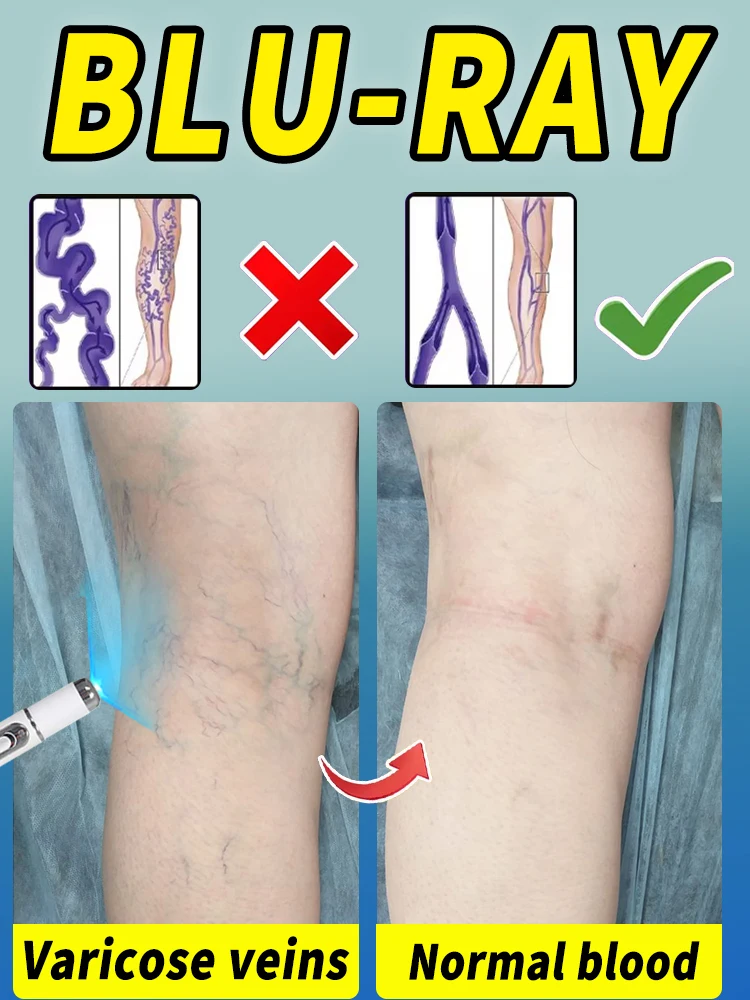 

Solve problems such as spider legs, varicose veins, phlebitis, etc. Improve blood vessels