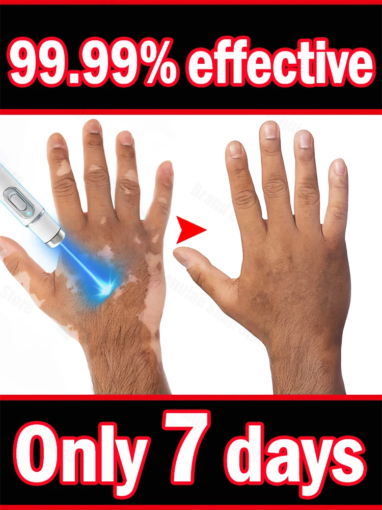 

Vitiligo Blue Light Lase Technology