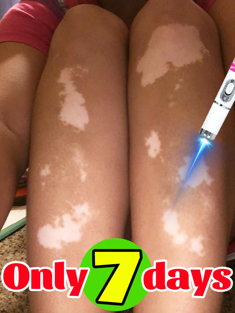 تفتيح البقع البيضاء العنيدة وتحسين جودة البشرة حقًا من الجذر