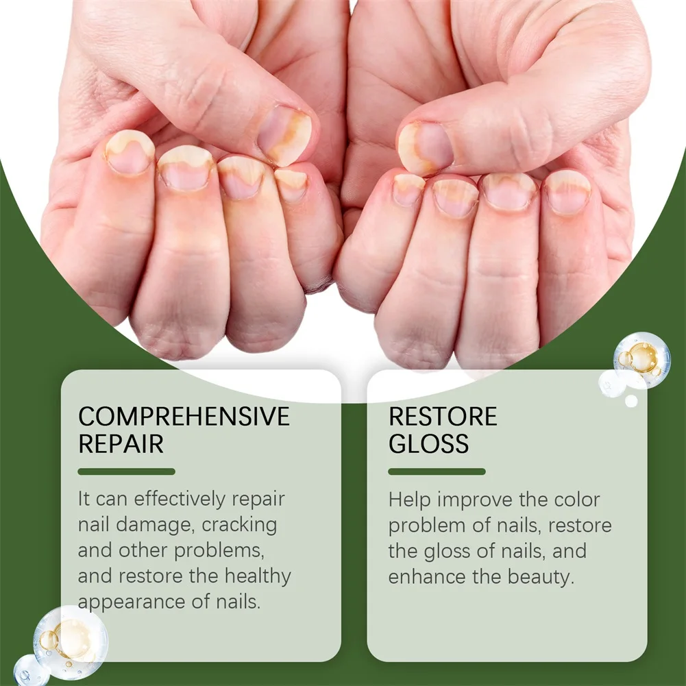 سائل تليين الأظافر لأظافر القدم السميكة، مصل إصلاح نمو الأظافر لجميع أنواع الأظافر