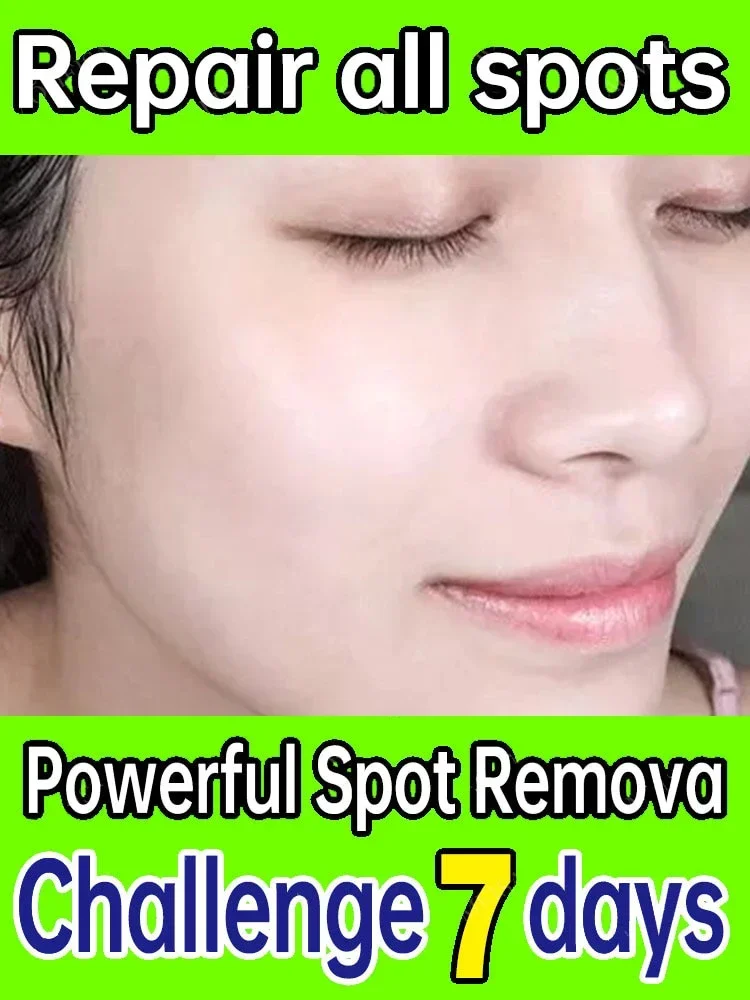 

Niacinamide Dark Spots Remover Serum Freckle Whitening Moisture Powerful Removal Black Dot Melasma Chloasma Face Skin Care Cream