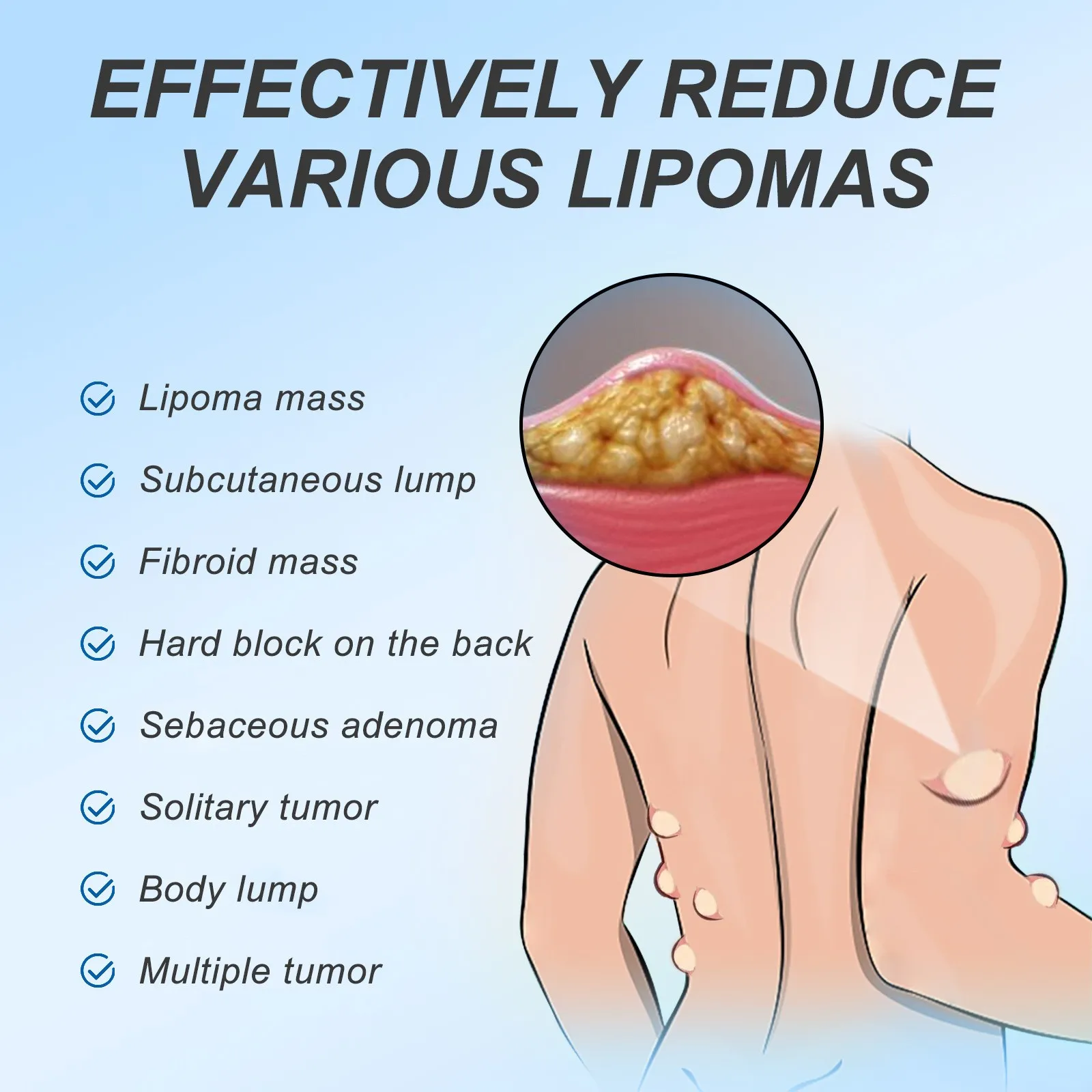 1 szt. Krem do usuwania lipoma leczenie obrzęk skóry lipoliza Fat Lump Eliminacja cellulitu Lump Nodule wygładzająca maść