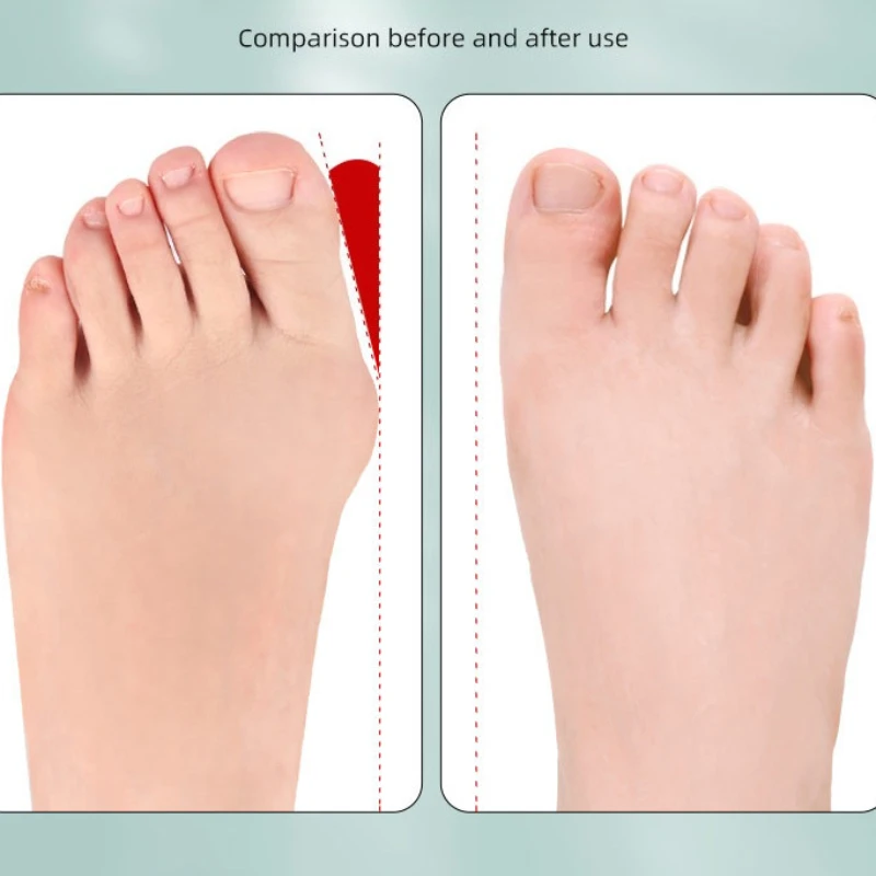 Hallux Valgus Corrector Belt RecoveryTraining Exerciser Strap Toe Separator Bunion Relief Exercise Tool Bunion Corrector Strap