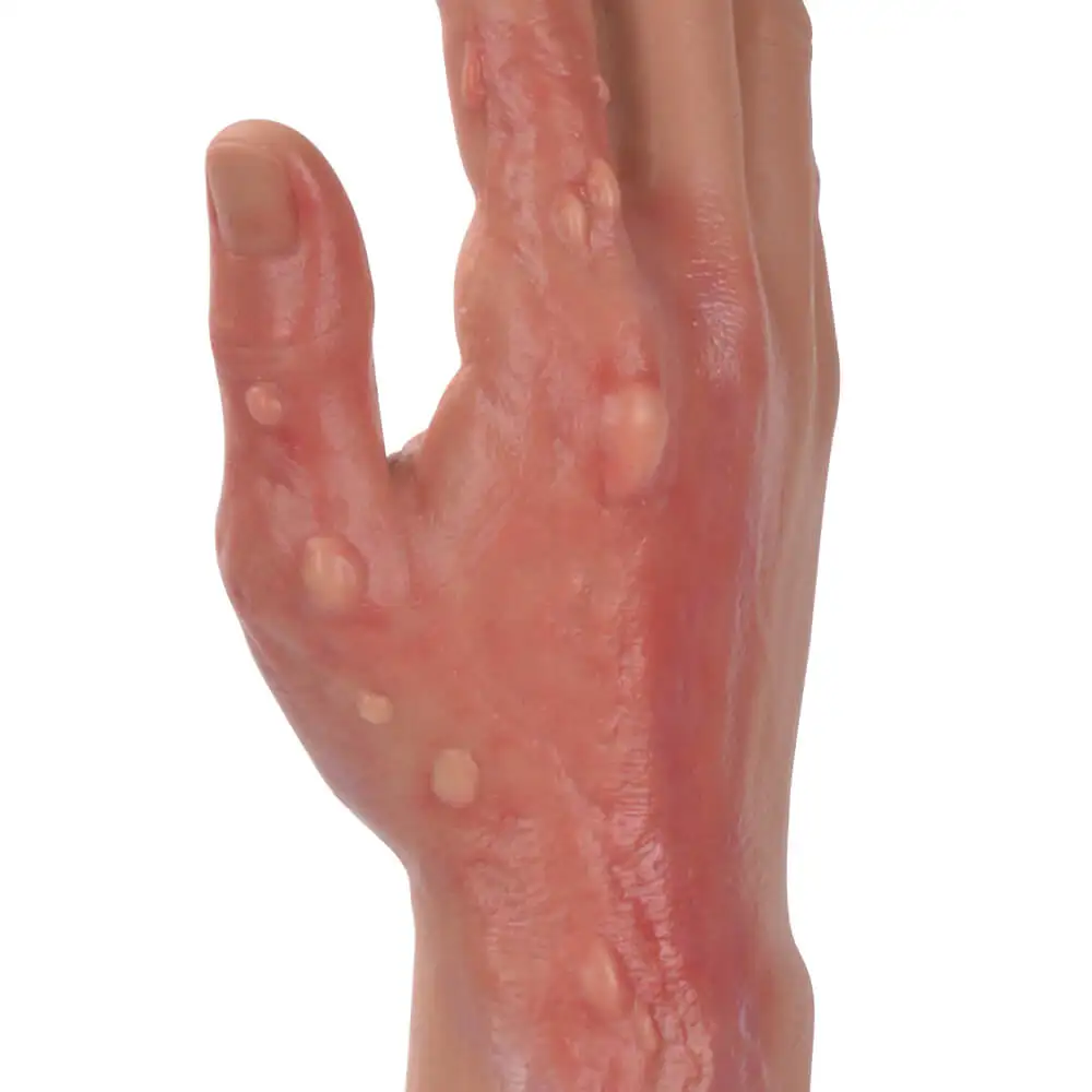 Multi-Degree Burn Wound Arm Training Model