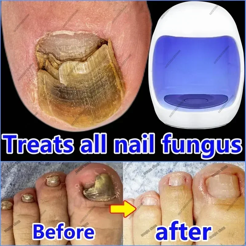 

About Fungal Nails, Laser Equipment, Fast Nail Repair, Fungal Onychomycosis