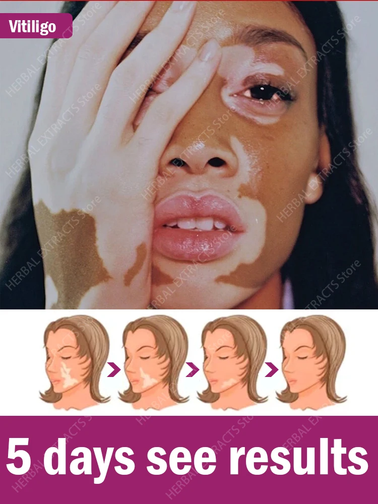 

Крем Vitiligo эффективно удаляет белые пятна