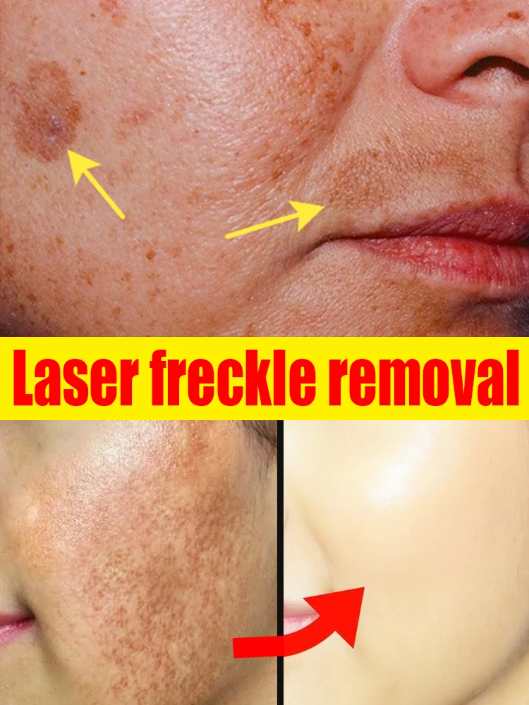 

Laser Dark Spots Melasma Freckles Face Whitening