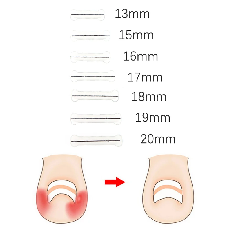 Ingrown toenail矯正ツール、成長したつま先の釘処理、弾性パッチステッカー、矯正クリップ、脚のペディキュアツール