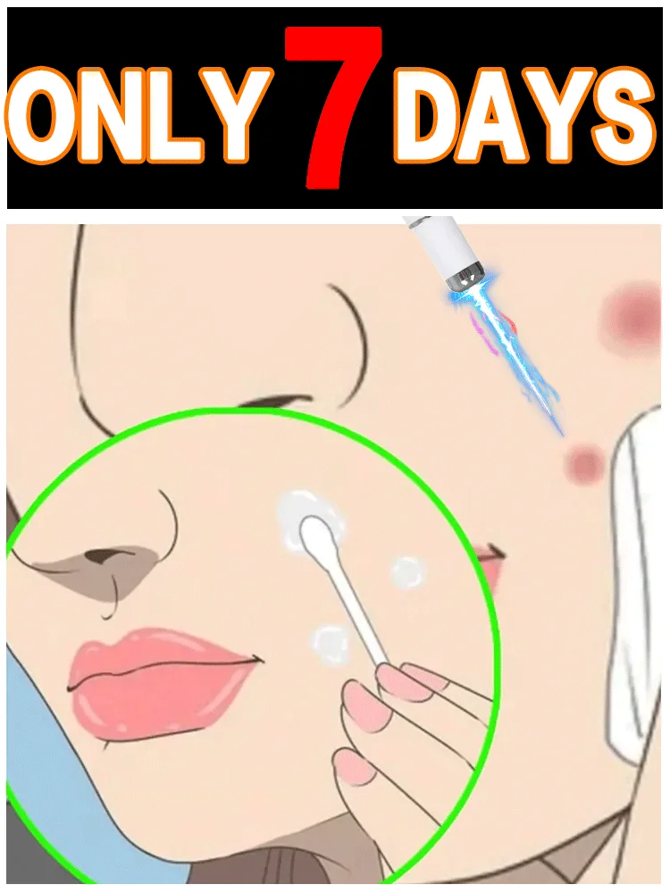 

2025's latest best-selling blue laser device, effectively removes flat warts.