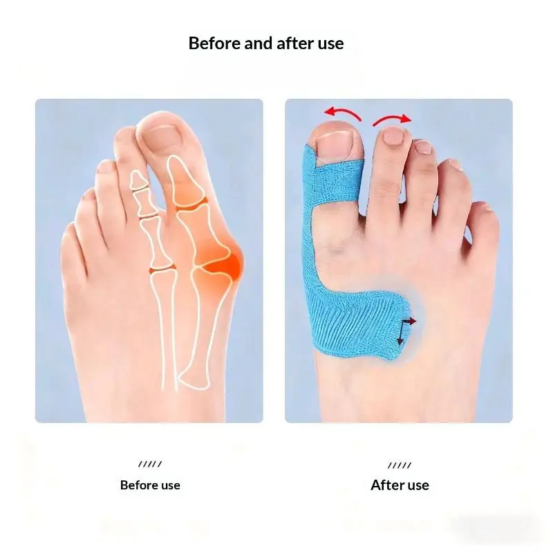 20 Stück Hallux-Valgus-Korrektoren Kinesiologie-Tape Großzehen-Separator Schmerzlinderung Athletische Fußpflege-Aufkleber – Detail 10