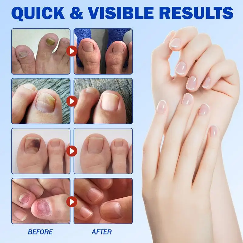 21 個足の爪パッチ柔軟な生地防水爪修理パッチ亀裂変色フットケア通気性陥入爪ステッカー