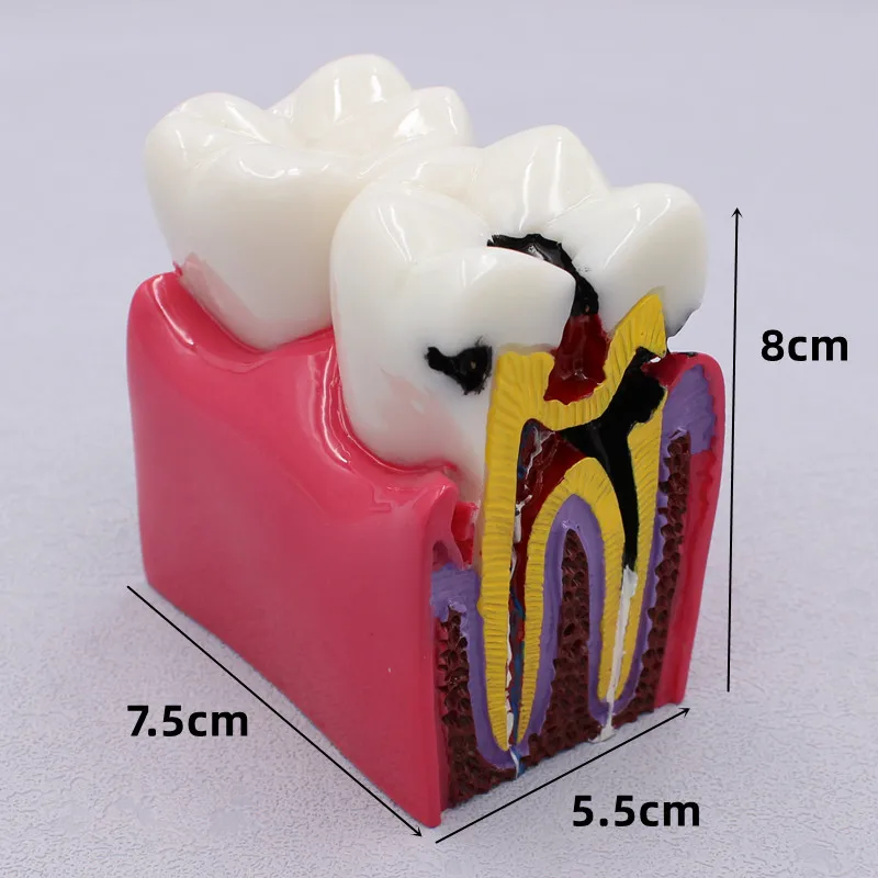 

1 pc Dental Materials Lab Teeth Model 6 Times Caries Comparation Study Models For Dentist Studying and Researching