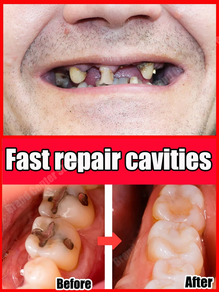 

Anti Caries Repairing Cavities Tooth Decay Repair