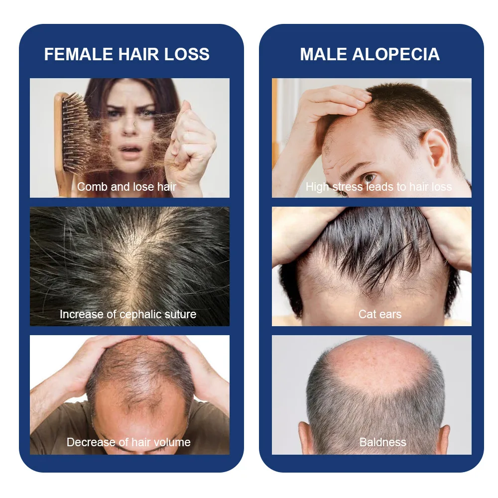 كريم نمو الشعر السريع المضاد لتساقط الشعر يمنع الصلع علاج فروة الرأس إصلاح الجذور الجمال الصحة العناية بالشعر للرجال والنساء