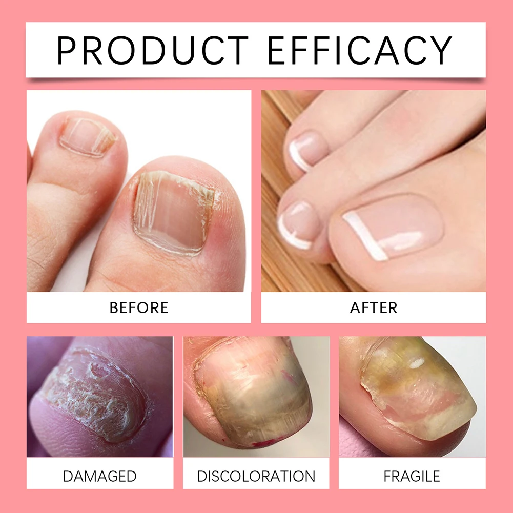 Nail Fungus Care Solution Anti-Infection Onychomycosis Repair Damaged Cracked Hand Foot Nail Manicureed Health Care Essence 15ml