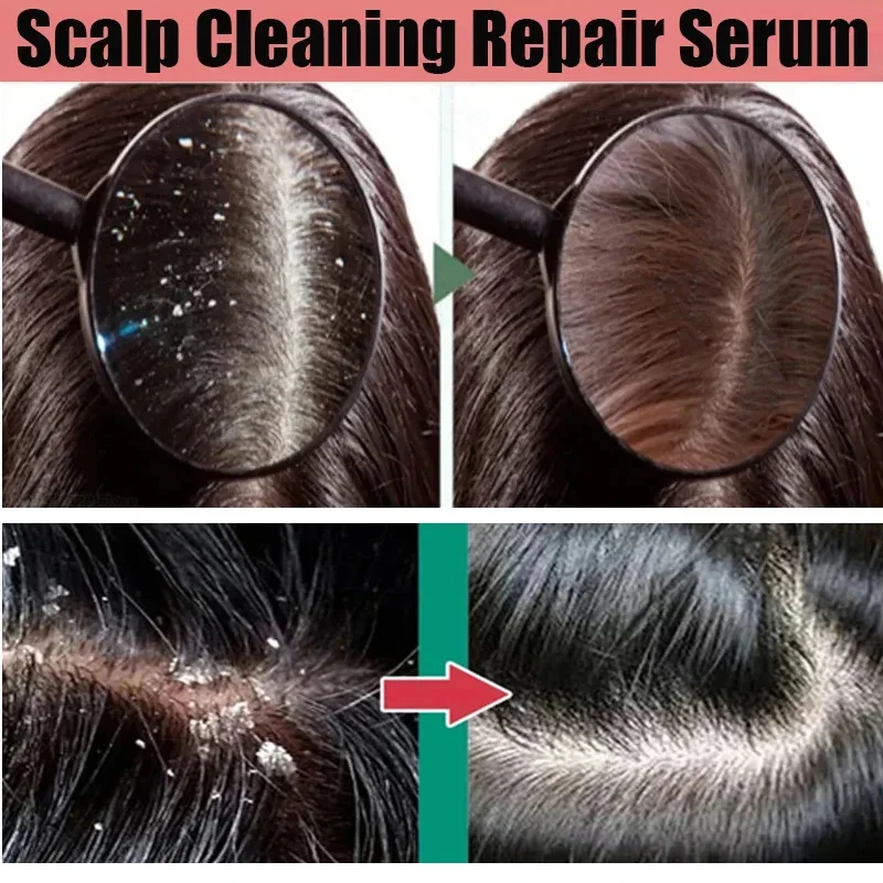 علاج فروة الرأس جوهر رذاذ القشرة الحكة السيطرة على النفط مكافحة فقدان فروة الرأس تنظيف إصلاح مصل منتجات العناية بالشعر الجمال