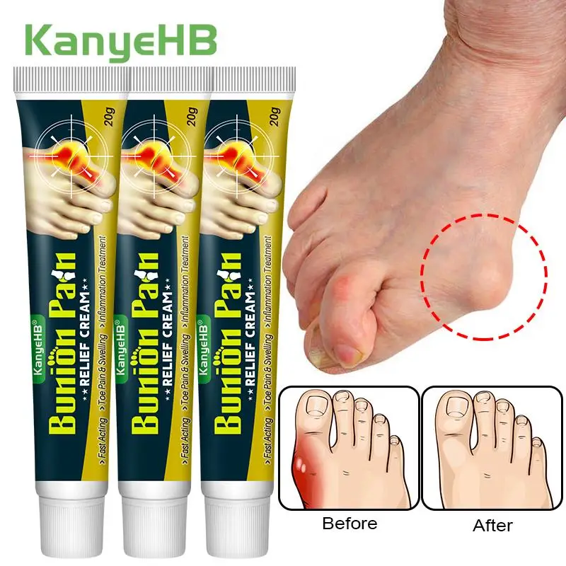 

3Pcs Foot Gout Treatment Cream Thumb Corrector Finger Hallux Ointment Toe Bunion Pain Relieve Medical Plaster Health Care A1790