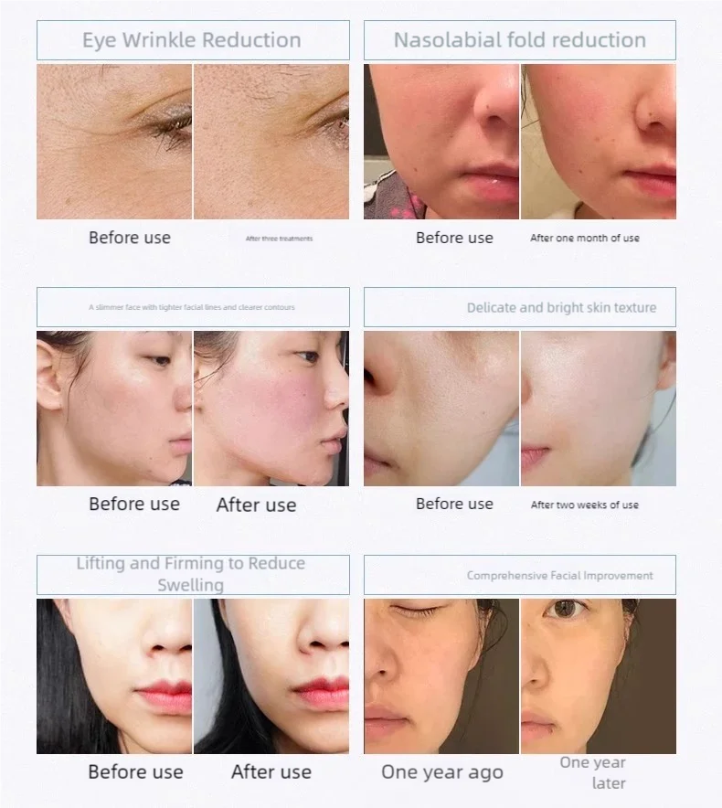 جهاز تجميل بالموجات فوق الصوتية متعدد الوظائف بتردد الراديو، تجديد البشرة الخفيفة، جهاز مضاد للشيخوخة مكركرنت، يحسن الصلابة، يقلل من التجاعيد، ويعزز امتصاص منتجات العناية بالبشرة #4