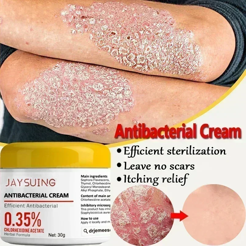 Psoriasis Moisturizing Cream Natural Repair Antibacterial Relieve Exfoliate Dry Skin Itchy Rough Skin Care Moss Removal