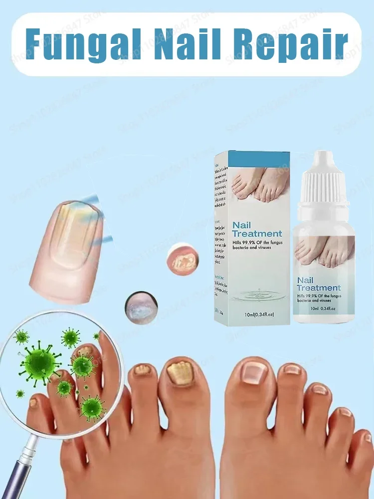 Onychomycosis reparatie serumzalf Onychomycosis paronychia zorgcrème Nagel teennagel voetverzorging reparatie Essence Oil