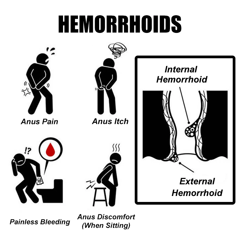 Hemorrhoid Ointment Treat Internal And External Hemorrhoid Anal Pain Itch Relief Cream Powerful Hemorrhoids Cream Huatuo Plaster