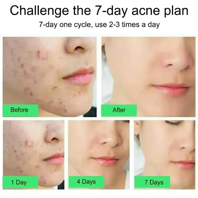Salicylic Acid Acne Removal Cream Anti-Acne Repair Redness Pimple Spots Deep Cleaning Pore Oil Control Moisturizing Skin Care image 4