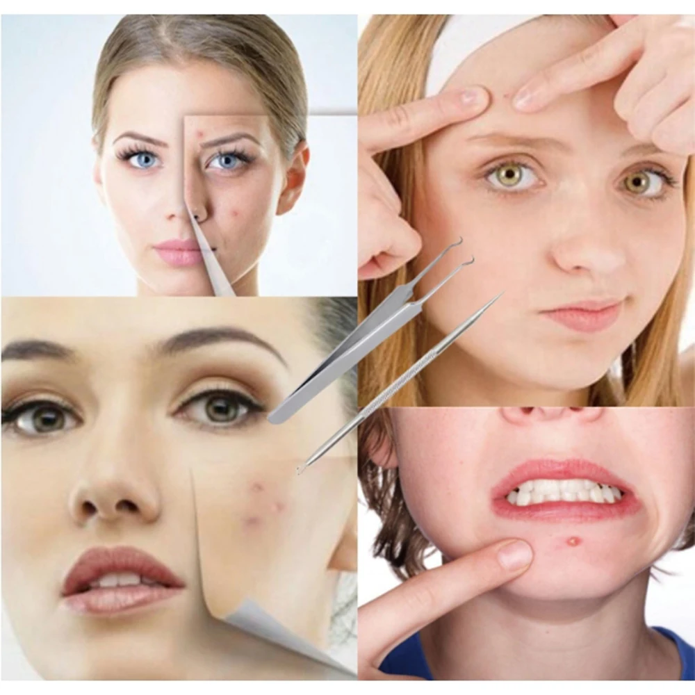 3 pçs/set clipe de acne de aço inoxidável, clipe de célula, clipe de cravo, agulha de acne, agulha de acne de salão de beleza, ferramenta de agulha de acne