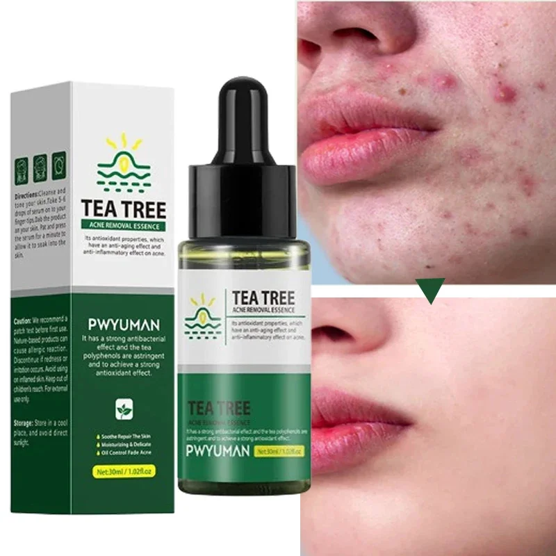 Tea Tree Acne Removal Serum Treatment Acne Serum Shrink Pore Remove Blackheads Facial Cleaning Fade Acne Marks Whitening