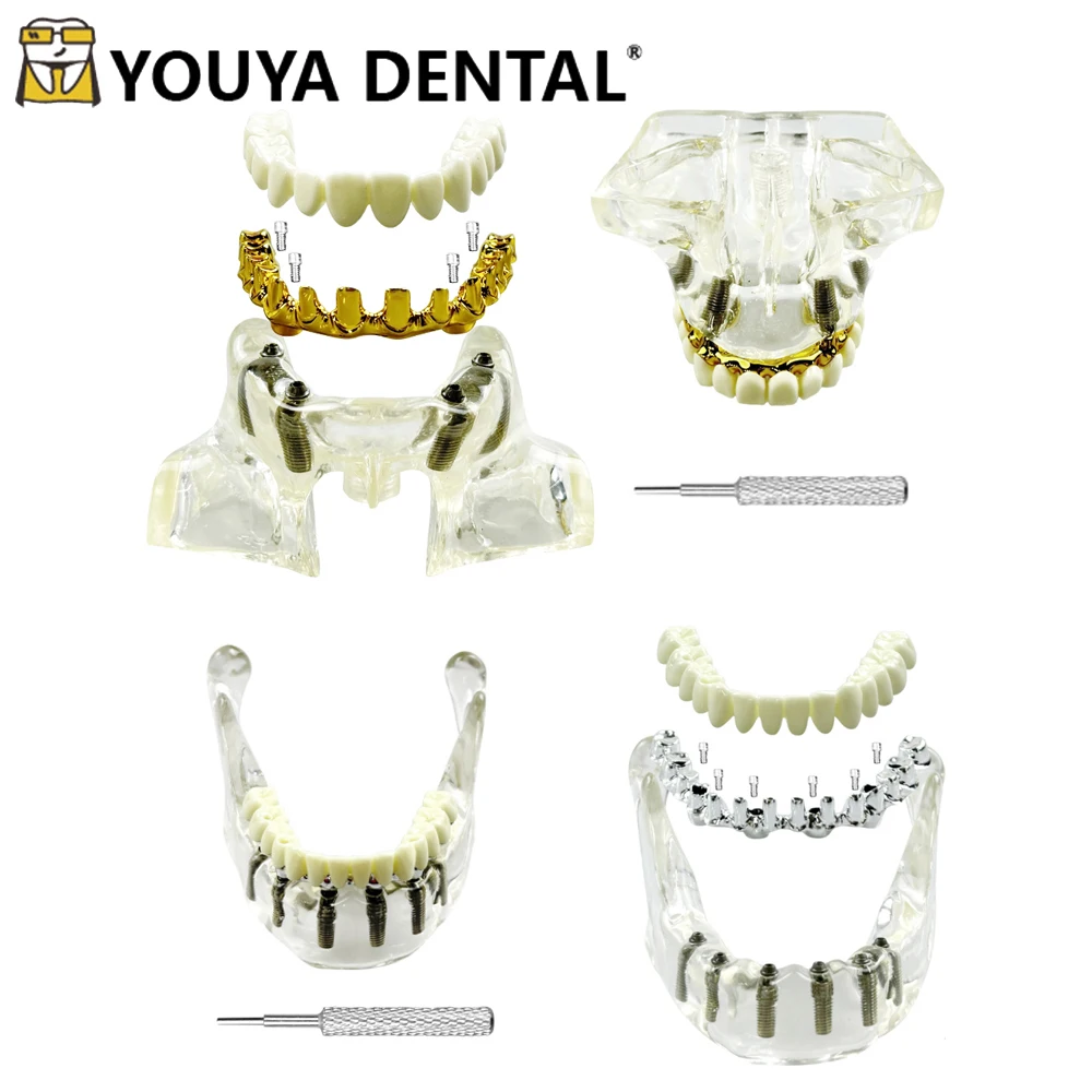 4/6 Implants Upper/Lower Jaw Dental Implant Model Transparent Dental Restoration Model Removable Overdenture Teaching  Model