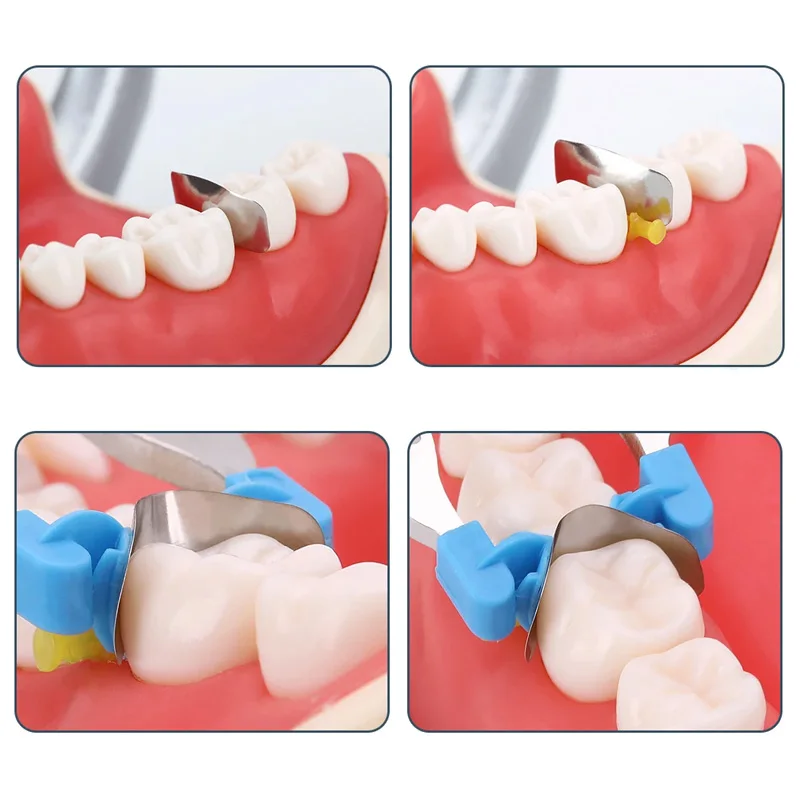 Dental Sectional Contoured Matrix System G2 30pcs Matrix Bands Refill +1pc Clamping Ring for Tooth Restoration Autoclavable