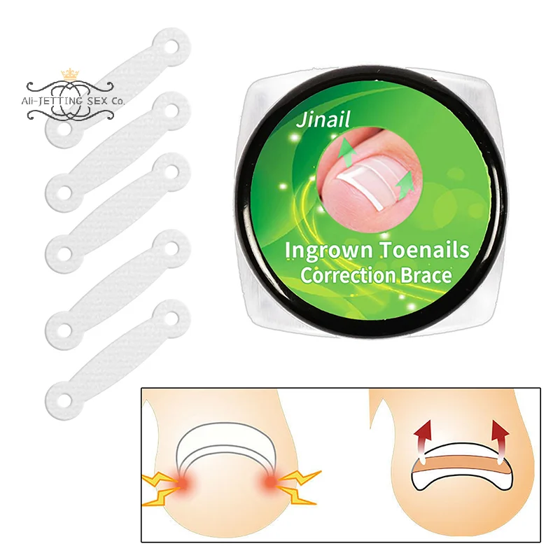 10PCS Strumenti per pedicure Trattamento delle unghie dei piedi incarnite Strumento di correzione dell'unghia del piede incarnita Adesivo patch elastico Raddrizzamento Clip Brace