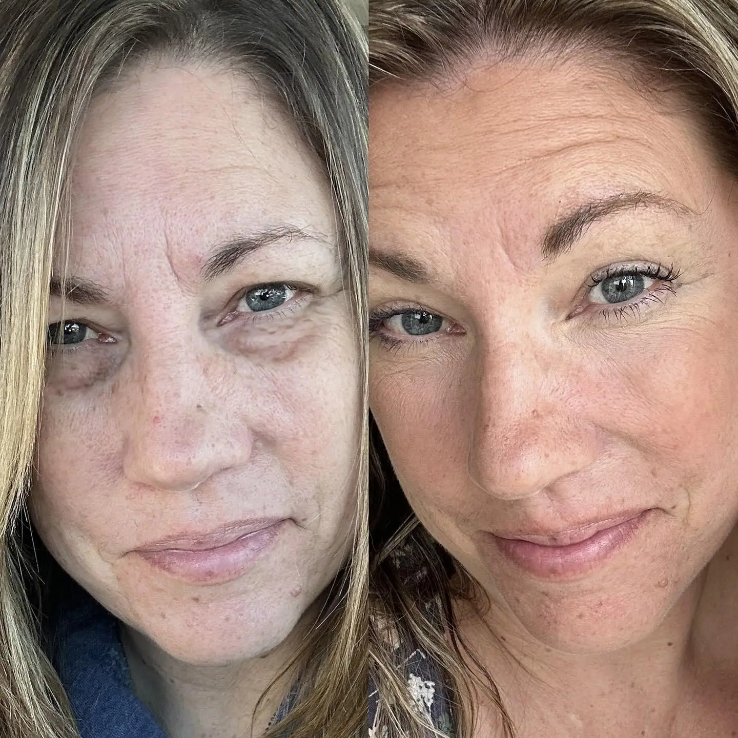 RevitalEyes by BOTANIQUE PARIS – Lunettes de luminothérapie rouge – Appareil sous les yeux pour les cernes