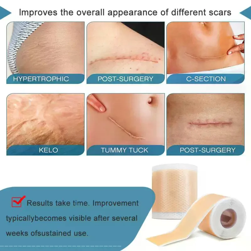 /YOV/150/300cm Silicone Scar Sheets Grade, Reusable Scar Tape For Keloid, C-Section, Surgery, Burn, Waterproof 1 Roll