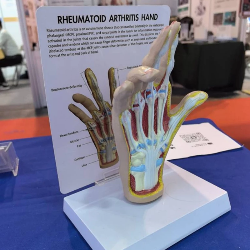 Modelo De Mão De Osteoartrite, Réplica De Anatomia Humana E Fisiologia, Modelo De Anatomia Do Escritório