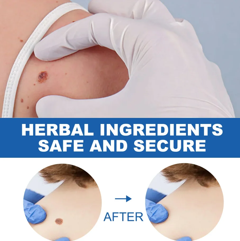 عرض ساخن لعام 2025، قلم الضوء الأزرق يحل الثآليل، أدوات العناية بالثآليل، للجنسين #4