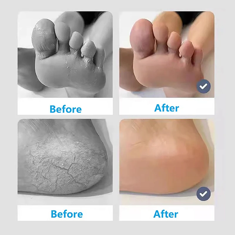 Exfoliëren Voeten Pedicure Handvat Puimsteen Schraper Voetvijl Dode Harde Ruwe Droge Huid Scrub Eelt Remover Handmatig Gebarsten Hakken
