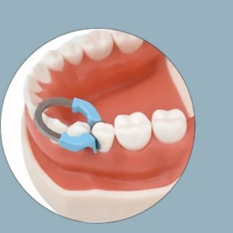 

Dental Sectional NITI Matrix System Matrix Bands Metal Matrices Clamp Universal/narrow Clamping Ring Nickel Titanium Material