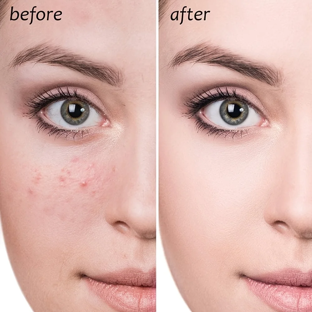 4ピースニキビ抽出セット、顔のニキビ、黒ずみ、ニキビを取り除くために使用され、肌を滑らかで柔らかくします。