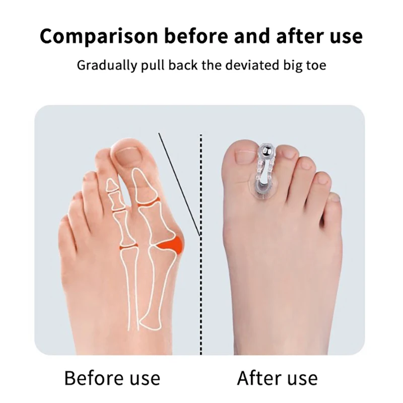 

1pcs Bunion Hallux Valgus Corrector Toe Spreader Separator Thumb Finger Correction Straightener Foot Care Tool
