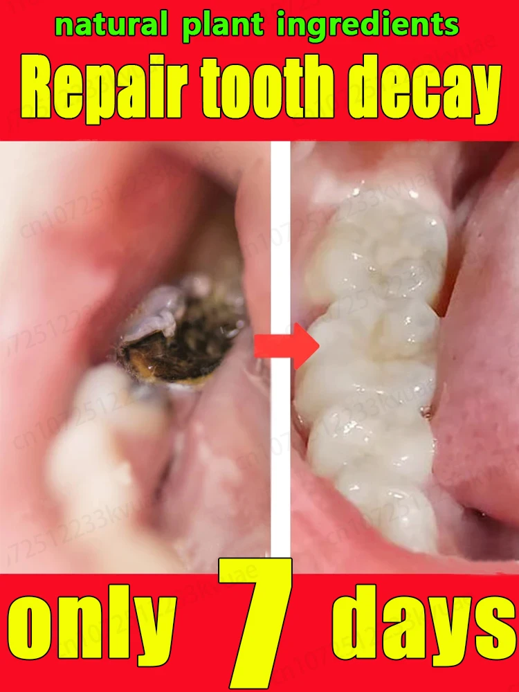 

Tooth decay repair, pure natural plant toothpaste, quick repair of tooth decay